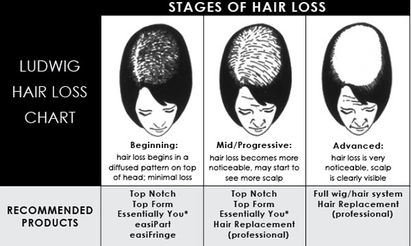 ludwig-hairloss-chart
